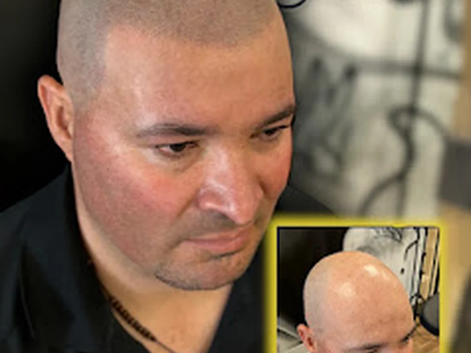 Toby Scalp - Micropigmentation, Tatouage Capillaire, Montréal